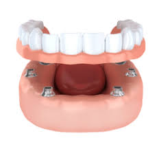Traditional dental implants are wider than mini implants and offer the greatest amount of stability which is critical for larger restorations. Implant Supported Dentures Sydney Double Bay Nsw