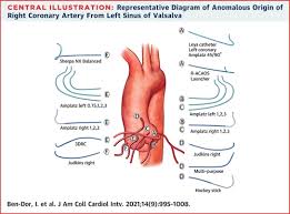 Anomalous definition, deviating from or inconsistent with the common order, form, or rule; Catheter Selection And Angiographic Views For Anomalous Coronary Arteries A Practical Guide Jacc Cardiovascular Interventions