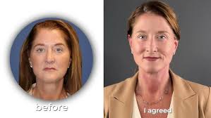 Facelift VIDEO CASE STUDY