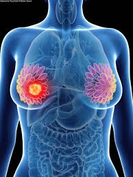 Find out what stage of cancer it is and if it will spread. Post Bi Rads 3 Mammogram Identifies Invasive Cancers