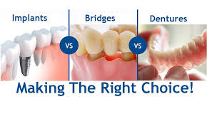 Dental Implants Vs Alternative Treatments For Missing Teeth Bogota Dental Center Dentists