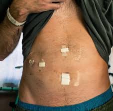 Incisions Dressed After The Surgery Gallbladder Surgery Laproscopic Surgery Gallbladder Surgery Diet