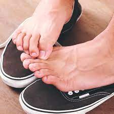 Athlete S Foot Common Signs Natural Treatments Dr Axe