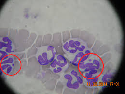 Asta ar fi un indicator al formarii active de trombocite. Hemoleucograma Jurnal Medical Yrra