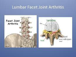 Primary Care Management Of The Degenerative Spine Jim