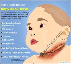 Home Remdies Baby Neck Rash Jpg 667 600 Baby Neck Rash Rash On Neck Baby Heat Rash
