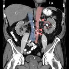 Image result for Calcium Nephrolithiasis