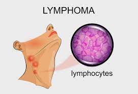 Lymph nodes in the neck. Lymphoma In Kids Reasons Symptoms And Treatment