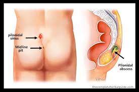 As the follicles become clogged with hair and skin debris, cyst formation occurs. Top Home Remedies For Pilonidal Cysts A Step By Step Guide On How To Get Rid Of Pilonidal Cysts Naturally