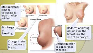 Inflammatory breast cancer (ibc). breastcancer.org: 8 Signs And Symptoms Of Breast Cancer 9 Download Scientific Diagram