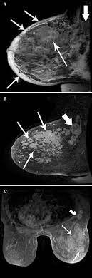 These symptoms can look and feel like infection or for other breast cancers, surgery is typically done first. Inflammatory Breast Cancer Pet Ct Mri Mammography And Sonography Findings Springerlink
