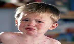 È, infatti, molto raro che determina malformazioni fetali e si trasmetta dalla madre al bambino, al. Scarlattina Sintomi Contagio E Cure In Bambini E Adulti