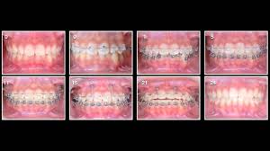 We did not find results for: Gummy Smile Correction For Kid Youtube