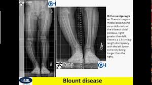 Blount S Disease Physiopedia