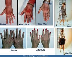 Image result for Dermatomyositis