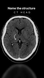 Image result for CT Head