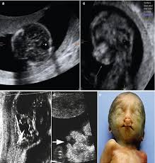 Image result for Micrognathia