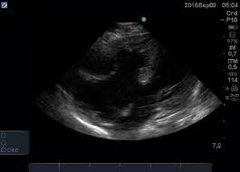 Image result for Endocardial Cushion Defect