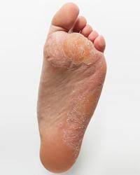 Hautpilz Ursachen Formen Diagnose Netdoktor At