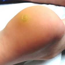 The removal is a gradual process, but part of the benefit is that future warts are prevented. The Most Problematic Warts Have No Sure Treatment Clinician Reviews