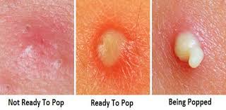 Skin picking ist eine echte erkrankung. Pickel Ausdrucken Deluxe Posts Facebook