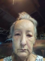 Killing invasive virginia creeper