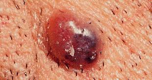 Read on to learn about identifying cancerous moles from benign marks. Is It Skin Cancer Cbs News