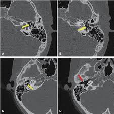 Image result for Ossicular Chain Disruption