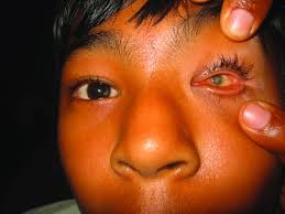 A 18-year-old male with left microphthalmus related to congenital...