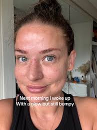 Hyaluronic Acid Serum Result