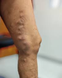 La trombosis venosa superficial es más fácil de detectar. Trombosis Venosa Superficial Varices Dra Vilma Lozano Facebook