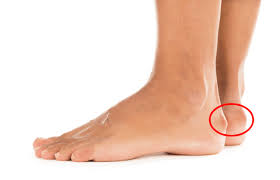 Robert faux explains haglund's deformity, a bony enlargement on the back of the heel, as well as how to treat it. Haglund S Deformity Cornerstone Foot Ankle