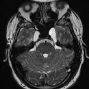 Image result for Meckel's Cave