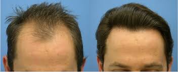 The results of the derma rolling hair loss trial described above are indeed impressive. Derma Roller For Hair Growth