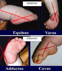 Children with congenital clubfoot often have residual deformity, pain, and limited function in adolescence and young adulthood. Demonstration Of Deformities Present In Clubfoot Download Scientific Diagram