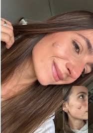 Mi realidad con quistes: evolución y experiencias