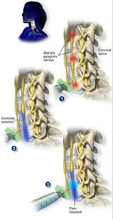 Pin On Complex Regional Pain Syndrome