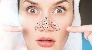 Cara menghilangkan jerawat flek hitam dan komedo. Cara Menghilangkan Jerawat Flek Hitam Dan Komedo Secara Alami