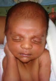 Identifying symptoms of Congenital Adrenal Hyperplasia