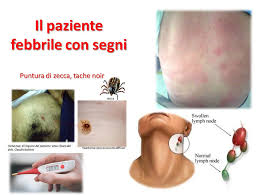Questi sospetti, generalmente, insorgono quando si manifestano alcuni dei seguenti sintomi Il Paziente Febbrile Ed I Segni Correlati Con La Febbre