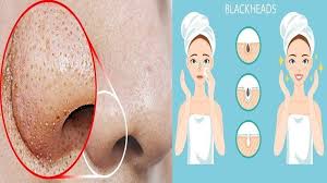 Pin On Ingrown Hair Prevention