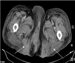 We did not find results for: Early Signs Of Fournier Gangrene Radiological Characteristics