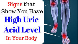 Uric acid is present in the blood and in moderate quantities. Signs And Symptoms Of High Uric Acid Level In A Body Home Remedy Resource