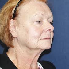 Facelift Before and After Photos by Brian Windle, MD; Aspen, CO