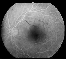 This means you may have had to wait longer than usual for your routine diabetic eye screening appointment. Diabetic Retinopathy Wikipedia