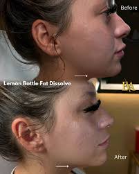 LEMON BOTTLE FAT DISSOLVE 🍋 #verifiedplug $150 any area all month!