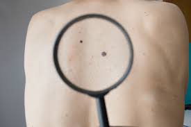 Mf can occur in people of any age, but most who get it are in their 50s or 60s. Risk Factors For Melanoma In Non Hodgkin Lymphoma Identified