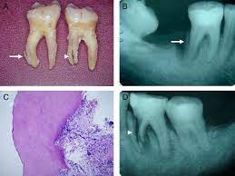 Apr 29, 2015 · mechanical locking into surface irregularities. Cemental Tear Clinical Characteristics And Its Predisposing Factors Journal Of Endodontics