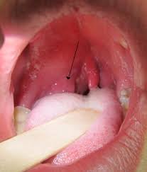 On the other hand, a lump that occurs without an infection or persists long after an infection resolves may be a sign of throat cancer. Peritonsillar Abscess Wikipedia