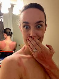 알로에, 그리고 다음번에는 선크림을 사용해. 내 동생은 흑색종으로 죽었어. ❤️❤️❤️❤️